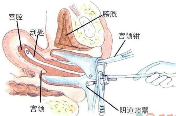 全面解读处女阴道出血咋办