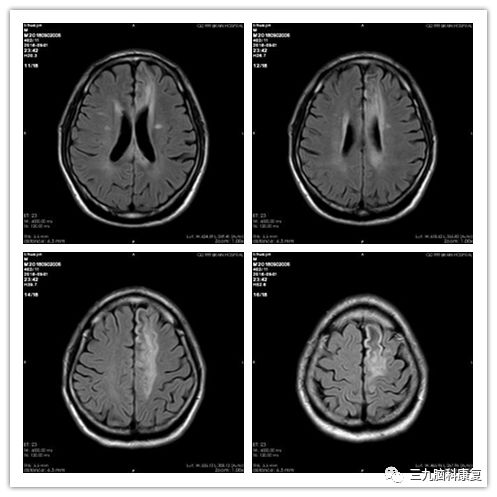 从影像定位看,此型病变部位位于胼胝体或左侧额叶
