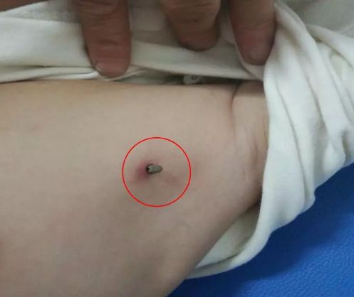 再次提醒千万小心这种虫子钻进体内严重可致死