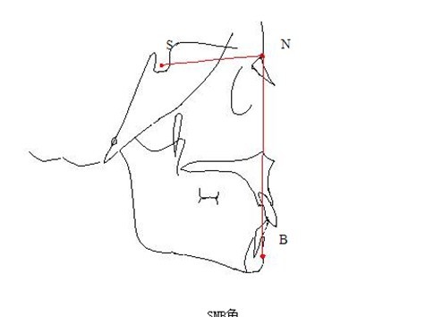 (snb角)当sna角过大时,上颌前突,侧面型就是典型的凸面型;当该角过