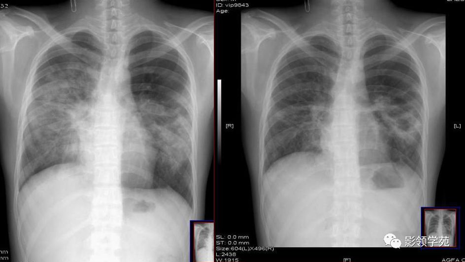 肺炎的影像诊断和鉴别诊断