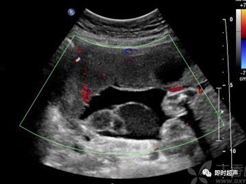 胎盘早剥超声诊断图片
