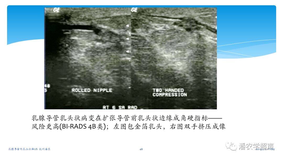 超聲微課堂乳腺導管內乳頭狀瘤超聲診斷