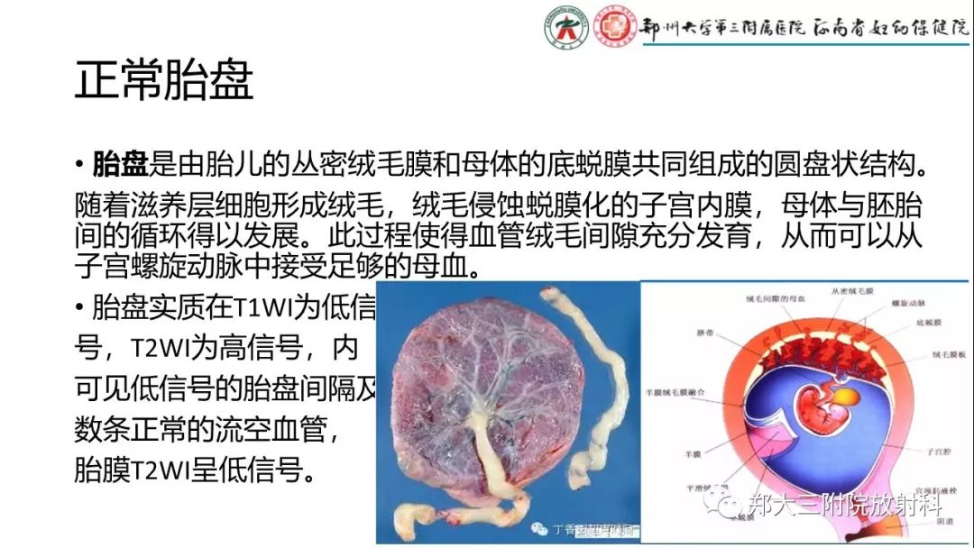 帆状胎盘的mri表现文献复习