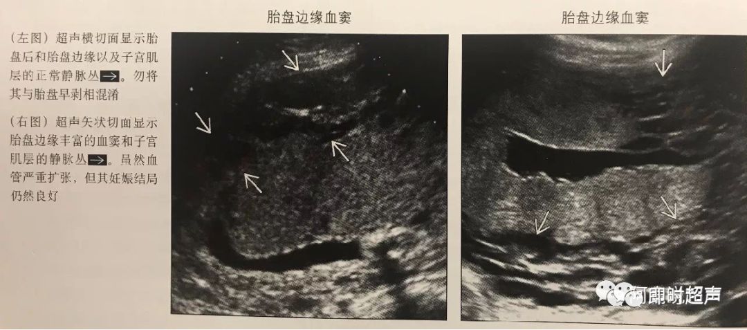 胎盘早剥超声诊断图片