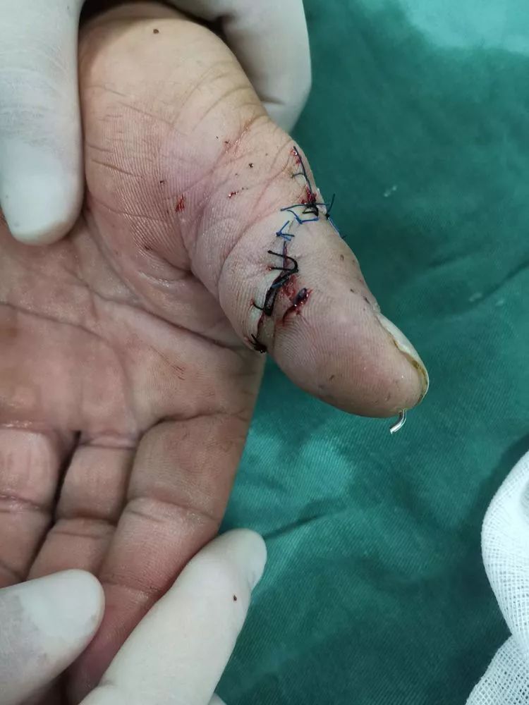 医生,请为我保留我的手指.