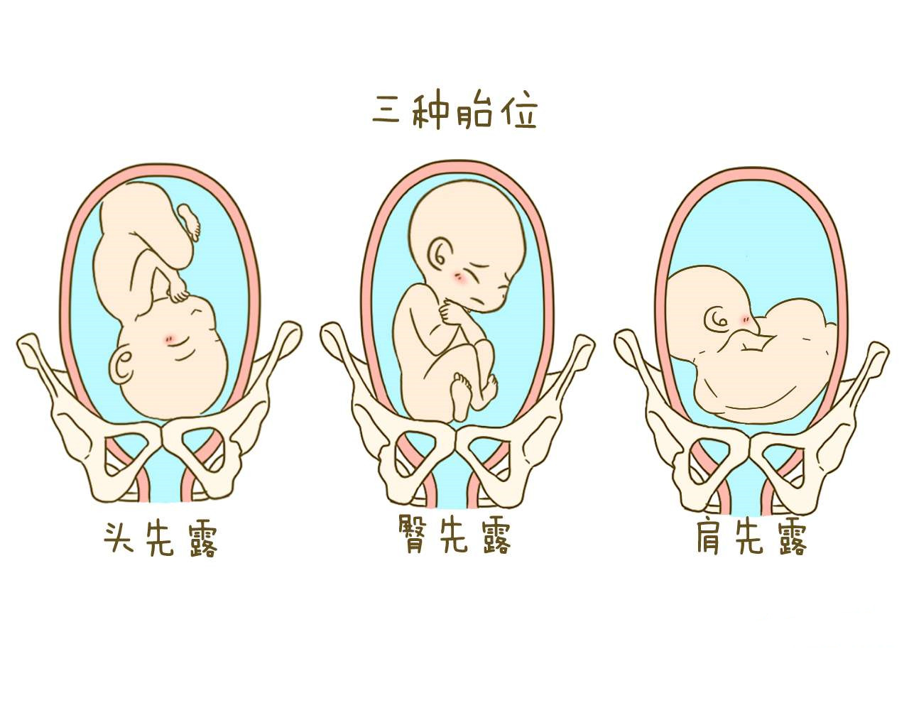胎位十字简易图 图解图片