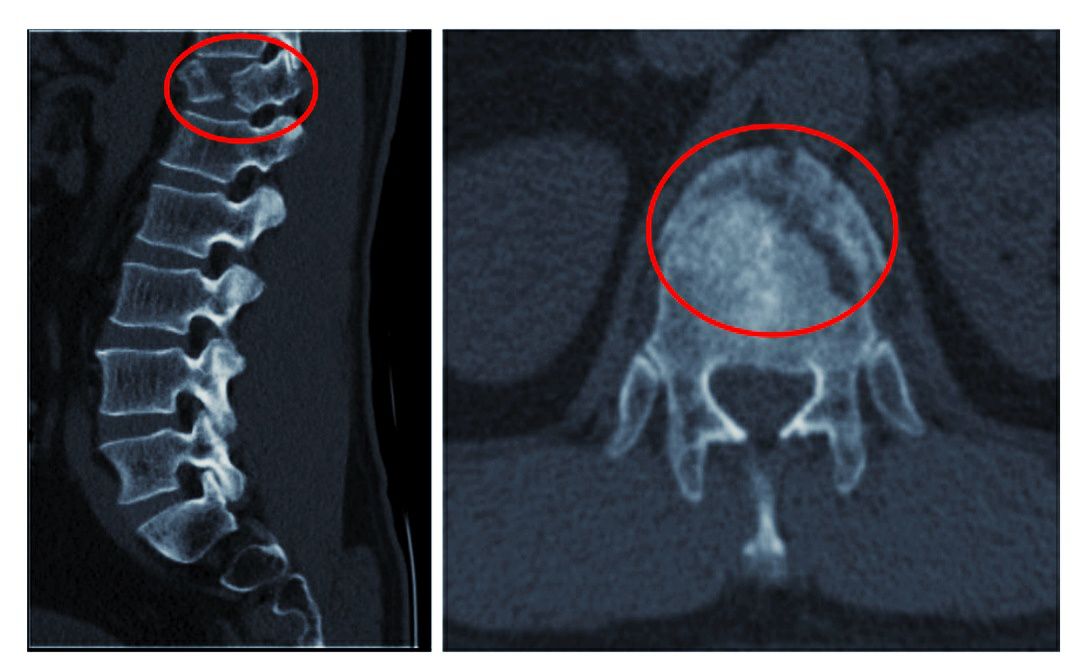 42岁司机开车时脊椎骨折开车时这个细节别再忽视