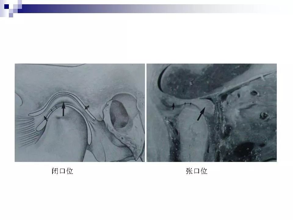 颞下颌关节的磁共振成像影像天地