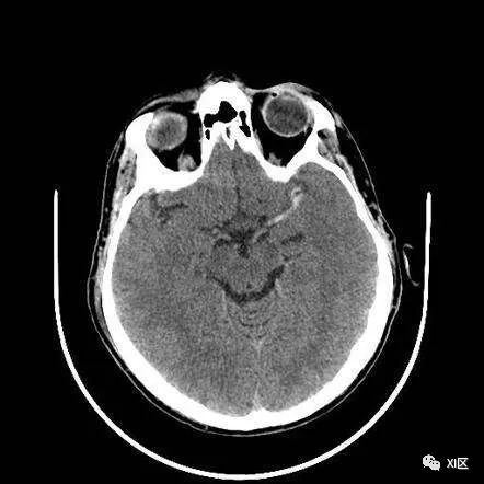头颅CT片子图片
