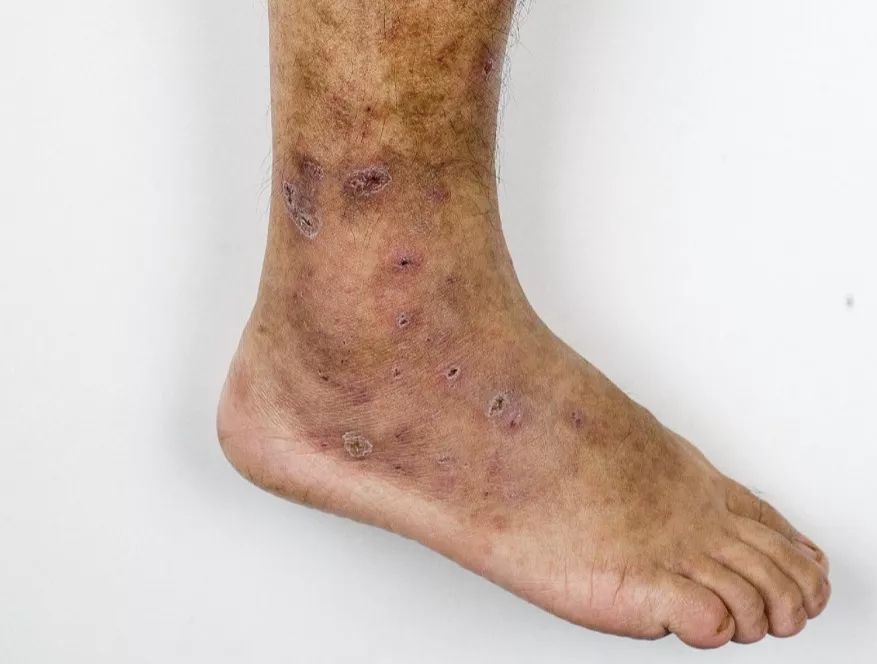 慢性静脉功能失调:包括一系列与静脉有关的疾病,从简单的毛细血管扩张