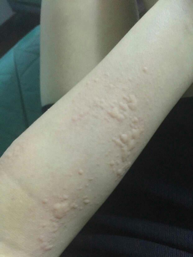 多年慢性荨麻疹竟是幽门螺杆菌作怪