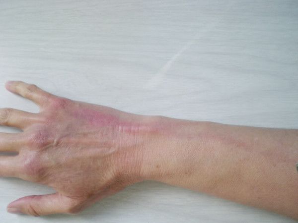 出现静脉炎该怎么办-搜狐大视野-搜狐新闻