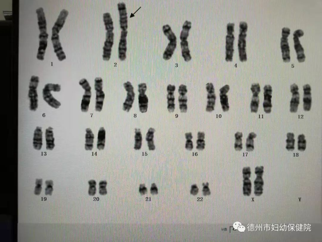 染色体图 女孩图片