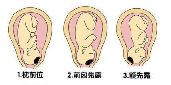 如果胎儿头在下方,臀在上方,就是头先露,这样的胎位叫头位,这是顺产的