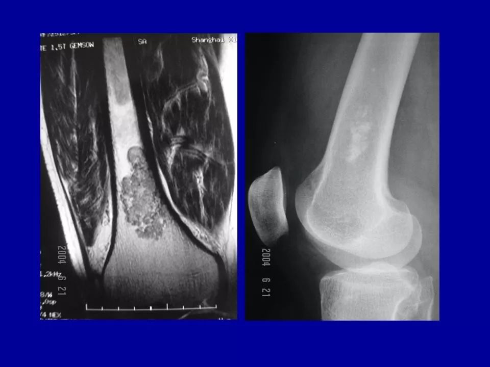 软骨母细胞瘤的影像诊断与鉴别