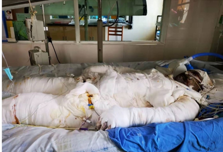 广州女公交司机因煤气爆炸全身烧伤90急需b型血