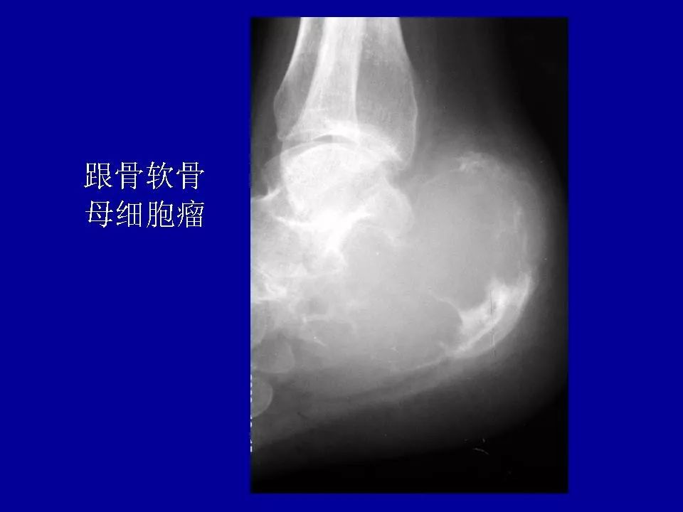 软骨母细胞瘤的影像诊断与鉴别影像天地