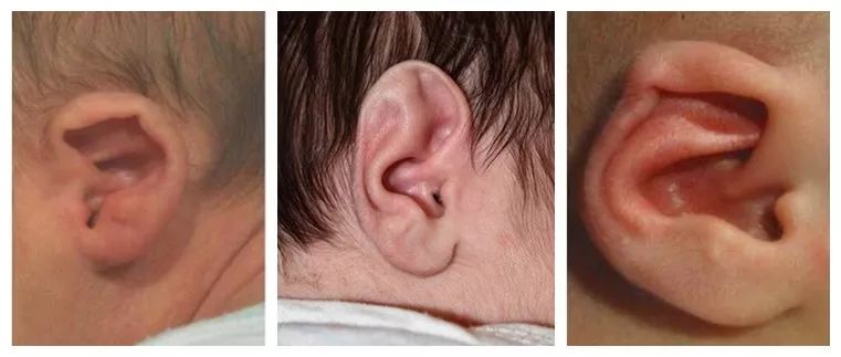 宝宝丨43%新生宝宝耳朵长歪?这些怪状娃中招了吗?