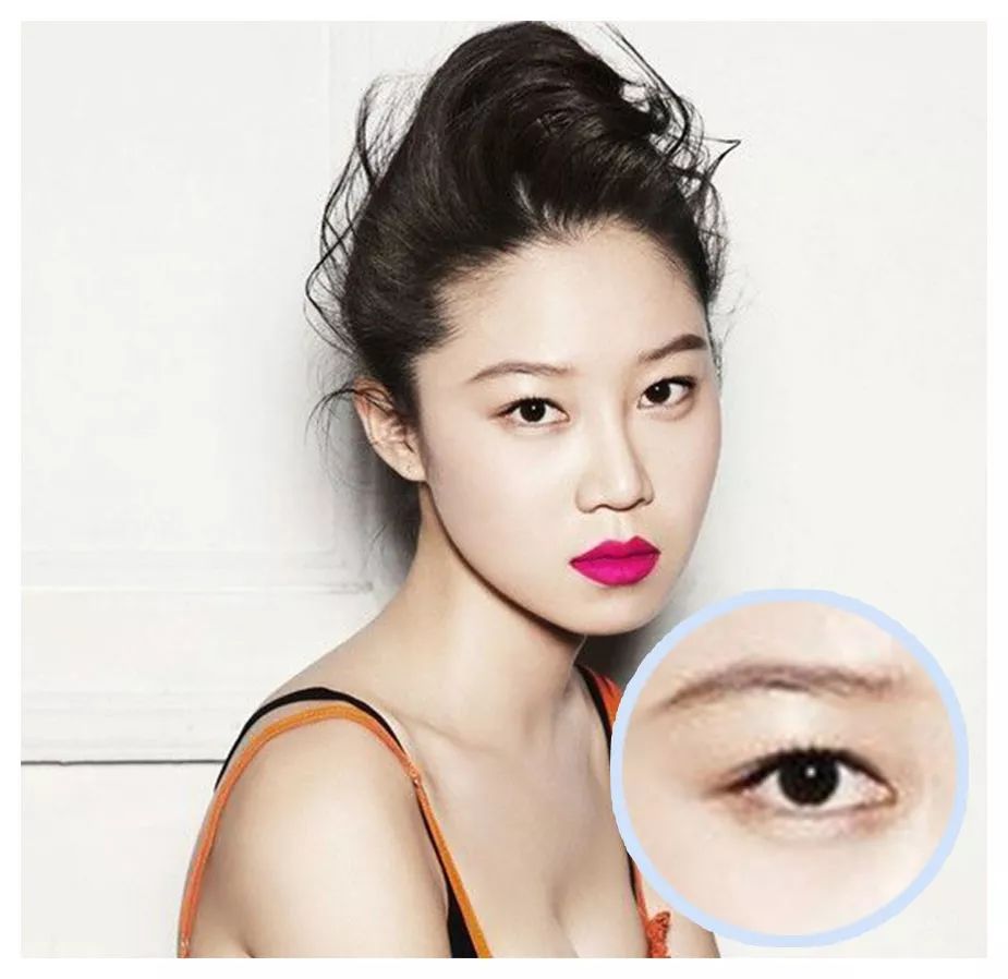 单眼皮,肿眼泡,内双也有救!