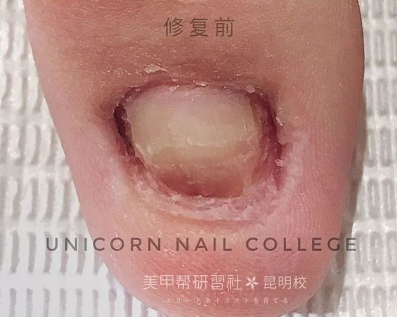 指甲萎缩是因为经常接触化学品使指芯受损,指甲失去光泽,严重时会使