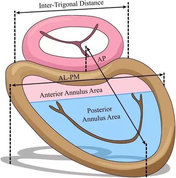 二尖瓣瓣叶瓣环图片