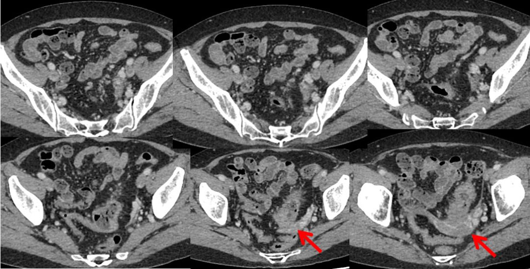 乙状结肠癌ct图片图片