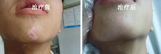 如果连头发都变白,那么在治疗的过程中存在一定的难度,虽然说白癜风长