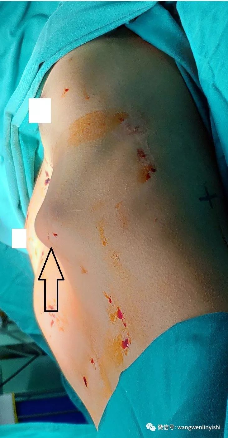 12高位鸡胸,采用wenlin手术完成治疗