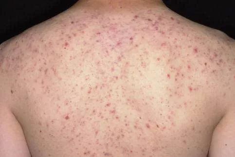 去后背痘痘其实也并不难改掉4个常见坏习惯3轻松方法祛痘