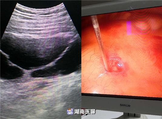 b超引导并腹腔镜监视下,顺利行经腹腔途径经皮肾穿刺.