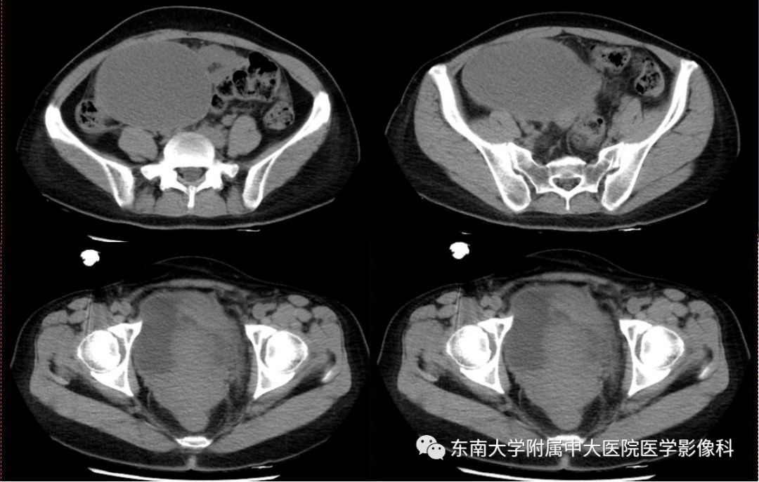 精彩推薦 | 子宮內膜異位症影像表現