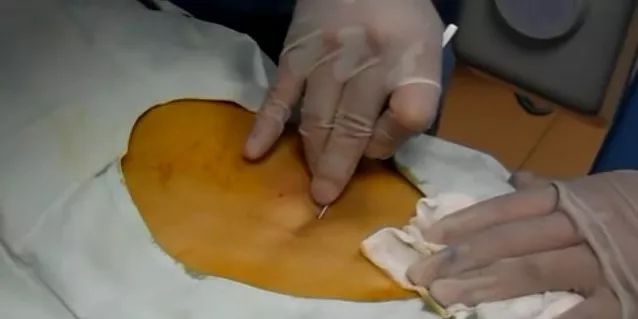 关节炎滑囊炎慢性软组织损伤腱鞘炎 网球肘其他拨针疗法适用于大面积