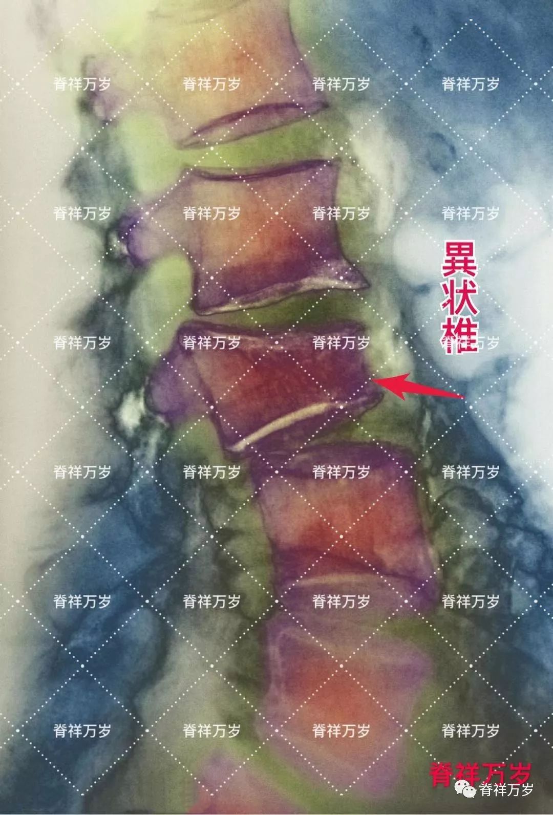 手法要特别注意的 多节段颈椎阻滞椎畸形