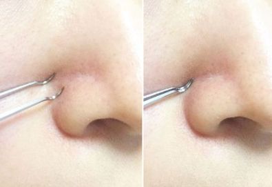 怎么有效去除黑头