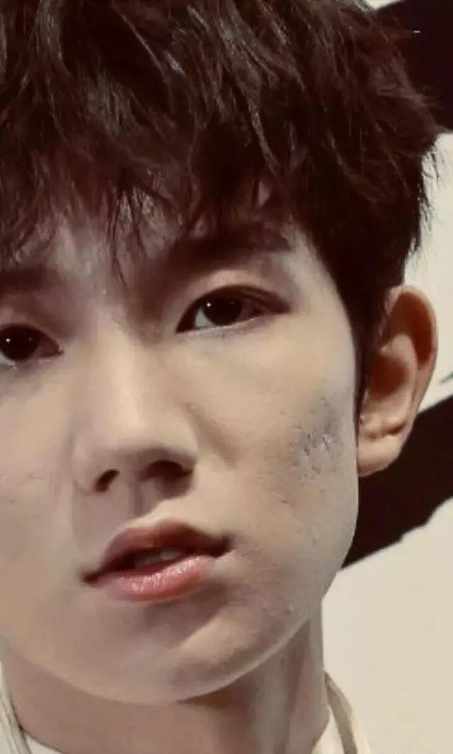 意外tfboys王源被爆重度痤疮演唱会现场未精修图曝光