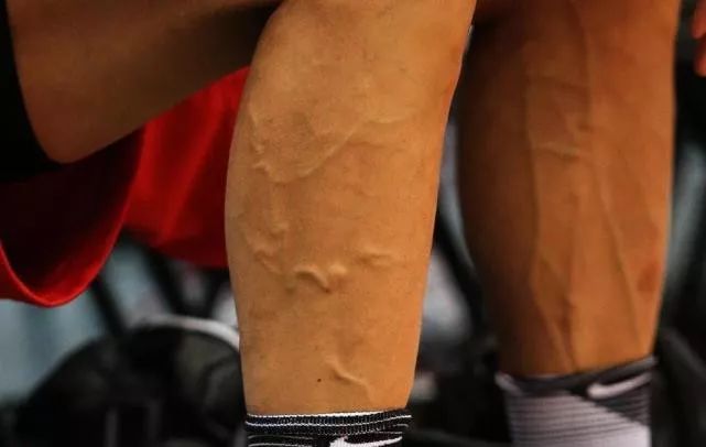 好物|「青筋凸起」,竟是人体废物积滞过多!