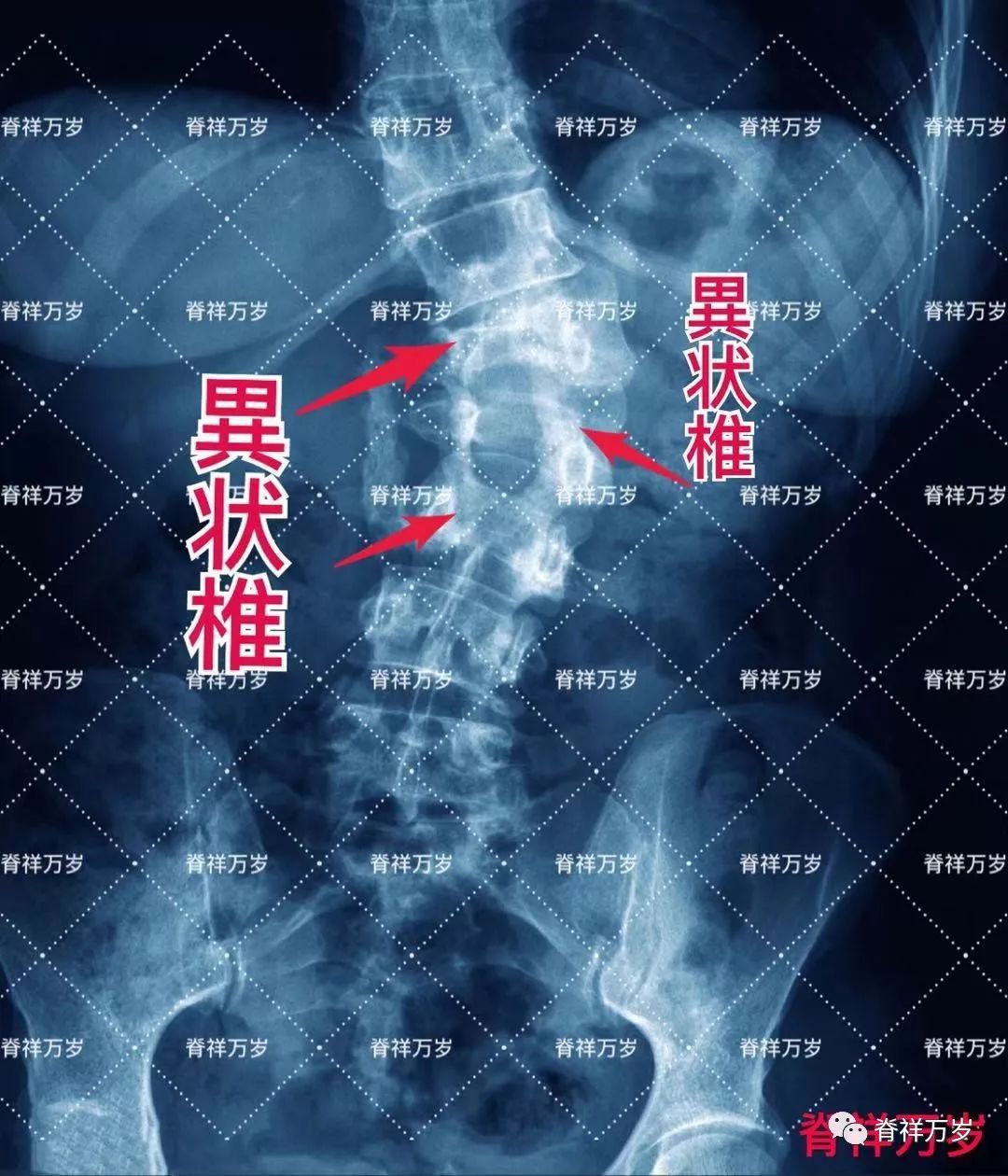 手法要特别注意的 多节段颈椎阻滞椎畸形