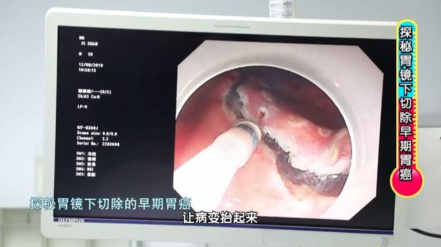 "拉肚子"竟然查出胃癌晚期?