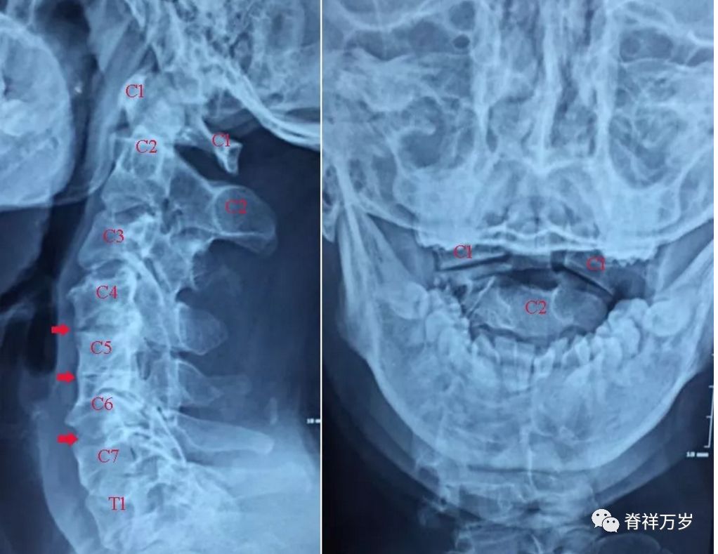 手法要特别注意的 多节段颈椎阻滞椎畸形