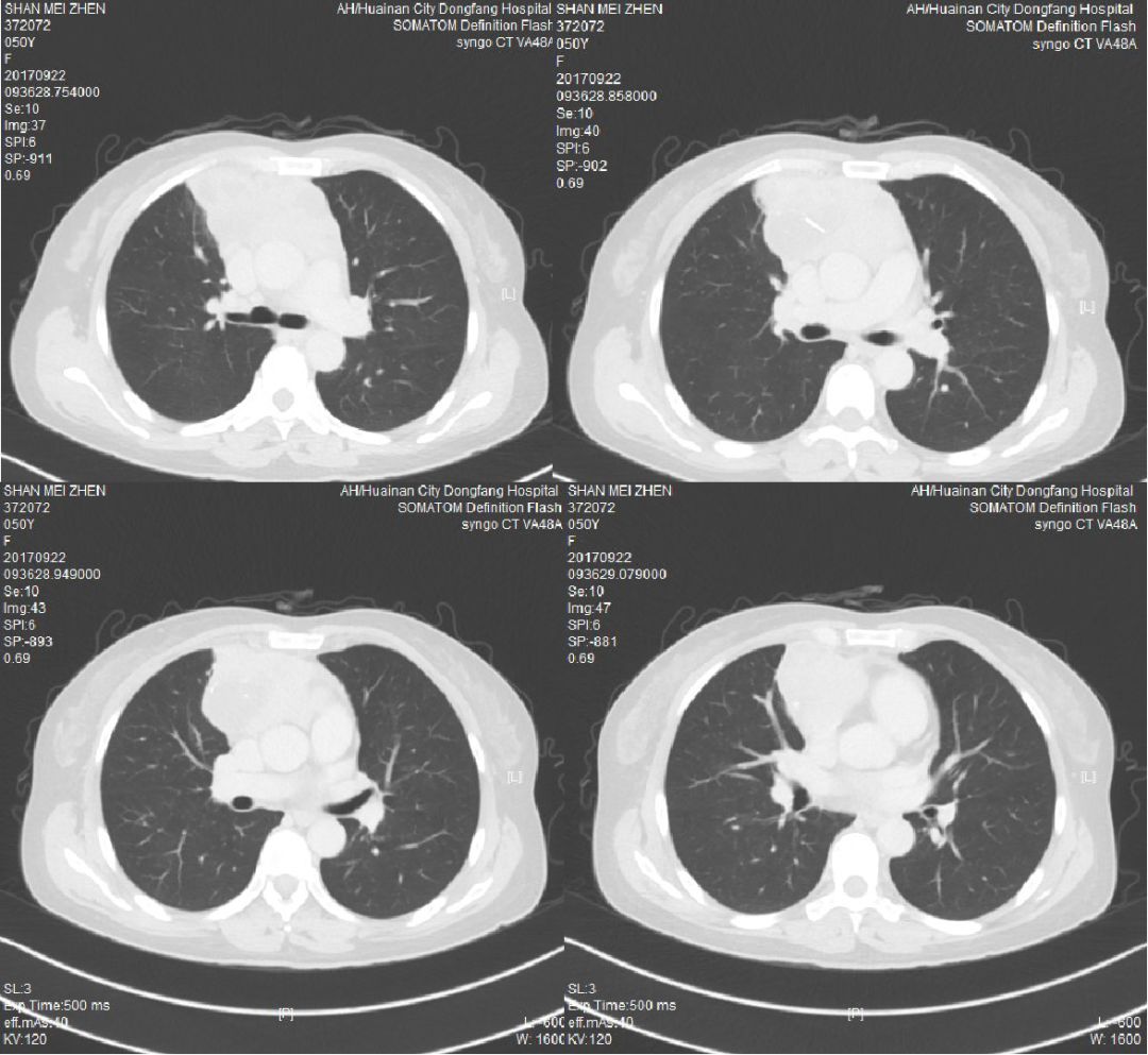 胸腺癌等你分析读片专栏1163期