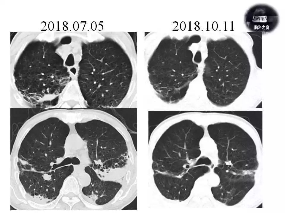 240期轮值病例结果肺奴卡菌病