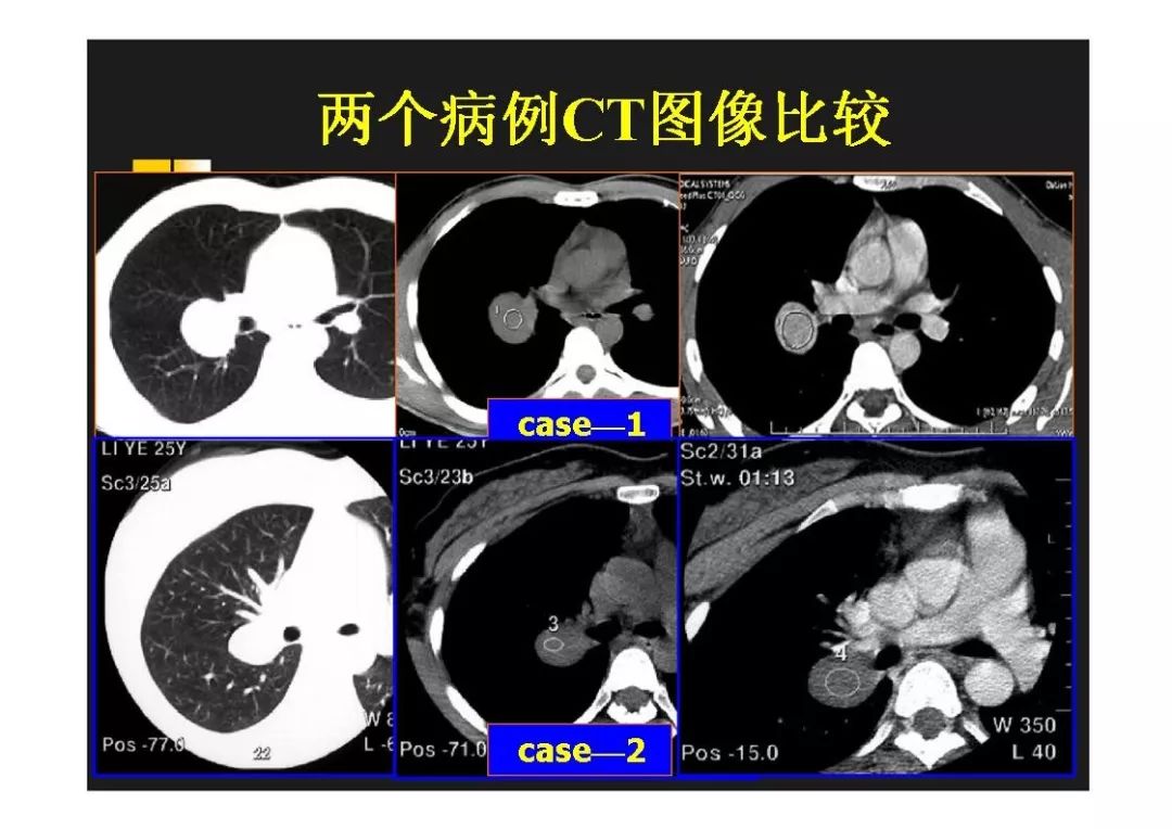 ct肺门位置图片