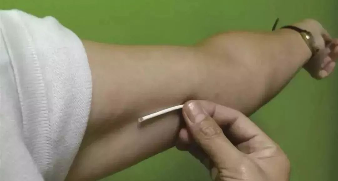 小小一根,避孕四年,你不可不知的皮下埋植避孕法