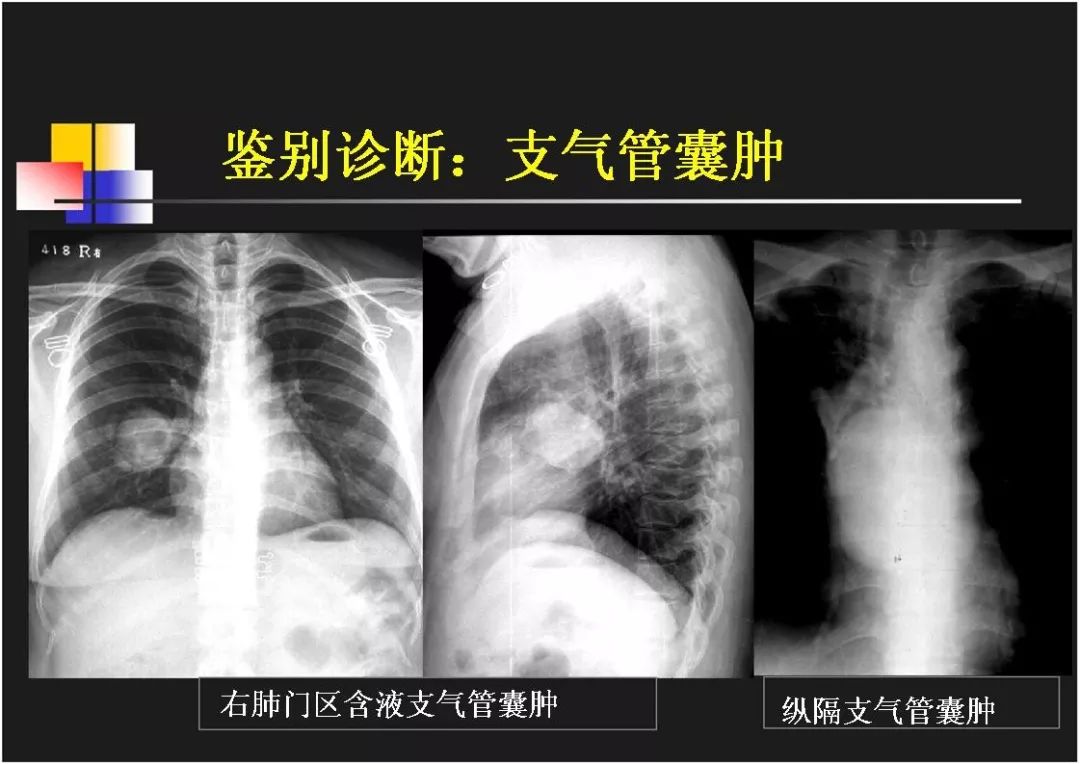 右肺门角图片