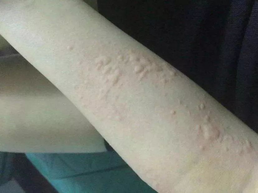 女子被它咬了一口!突然休克,浑身长满疙瘩