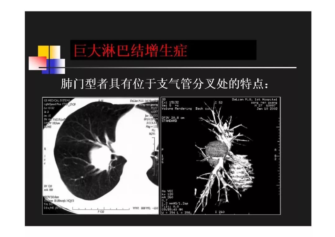 右肺门角图片