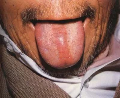 【主病】素体阴亏,胃阴不足;气血不足,中气衰竭;胸脘湿热或肝胆湿热.