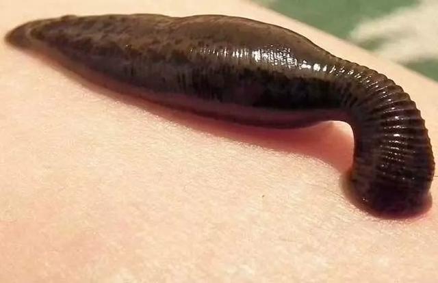 下狠手为治痘痘小伙买了10条活蚂蟥放脸上使不得啊