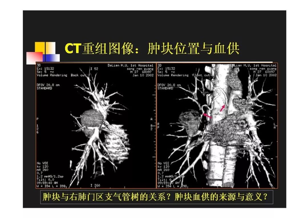 右肺门区类圆形肿物的鉴别诊断影像天地